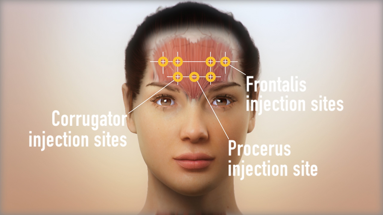 Allergan
